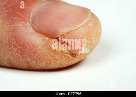 Mans Fingerspitze aufgeteilt aufgrund des kalten Wetters vor einem weißen Hintergrund. Stockfoto