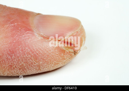 Mans Fingerspitze aufgeteilt aufgrund des kalten Wetters vor einem weißen Hintergrund. Stockfoto