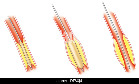 ARTERIELLE ANGIOPLASTIE, ABBILDUNG. Stockfoto