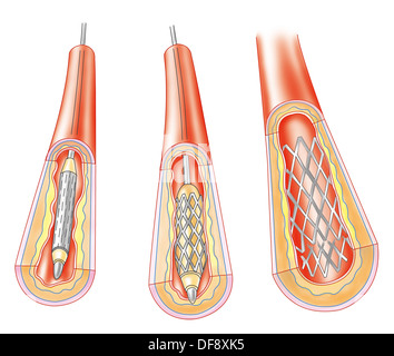 ARTERIELLE ANGIOPLASTIE, ABBILDUNG. Stockfoto