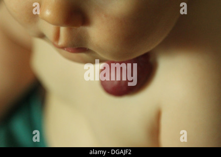 Baby mit einem Hämangiom auch als Erdbeer-Muttermal genannt Stockfoto