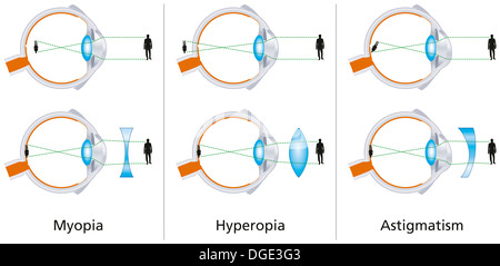 Sehfehler - Kurzsichtigkeit, Weitsichtigkeit und Hornhautverkrümmung Stockfoto