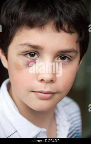 Jungen Jungen mit einem Blackeye. Stockfoto