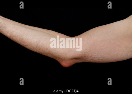 Olecranon Bursitis, ist eine Erkrankung, die durch die Entzündung der Schleimbeutel unter dem Ellenbogen Olecranon durch Trauma verursacht Stockfoto