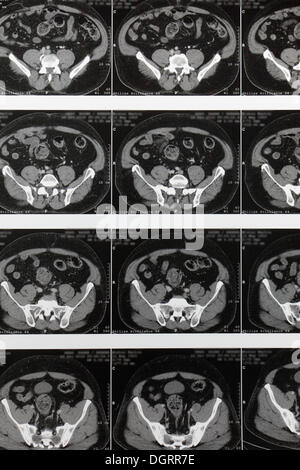 Mehrschicht berechnet, Computertomographie, Magnetresonanztomographie, MRT-Untersuchung der inneren Organe Stockfoto