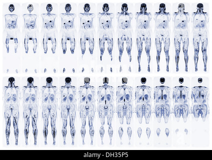 Komplette real MRT-Untersuchung des menschlichen Körpers, von der Vorder- und Rückseite Stockfoto