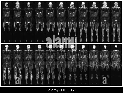 Komplette real MRT-Untersuchung des menschlichen Körpers, von der Vorder- und Rückseite Stockfoto