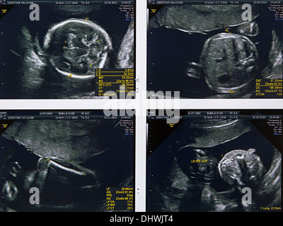 FÖTUS, SONOGRAPHIE Stockfoto