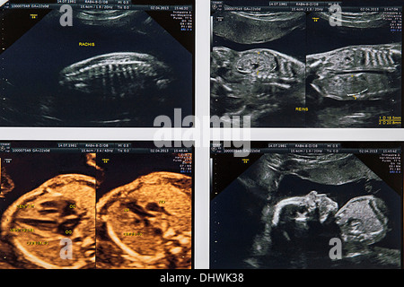 FÖTUS, SONOGRAPHIE Stockfoto