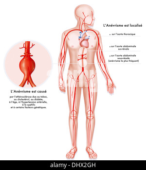 ANEURYSMA EINER ARTERIE, ZEICHNUNG Stockfoto