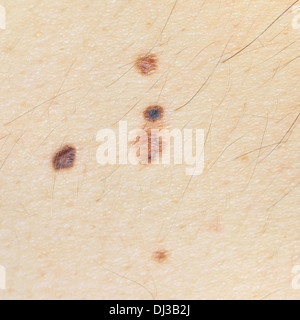 Close-up vier Nävi auf der Haut auf kaukasischen Männer zurück. Verdächtig aussehende compound Nävus (1-3 mm) Biopsie der Haut eingestuft. Stockfoto