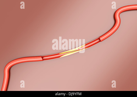 Arteriosklerose. Plaketten, die Verschärfung einer Arterie. 3D gerenderte Darstellung. Stockfoto