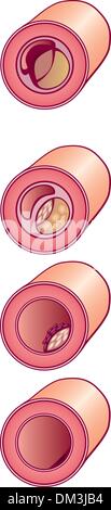 schlechtes Cholesterin Stock Vektor