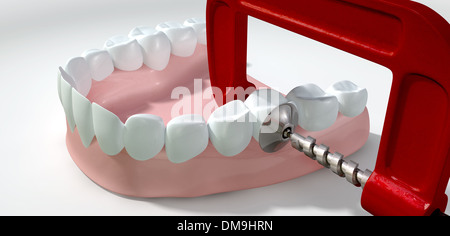 Ein Zahnschmerzen-Konzept zeigt einen einzelnen Zahn verdrängt durch eine Rot-Metall Klammer auf einem isolierten weißen Studioaufnahme Stockfoto