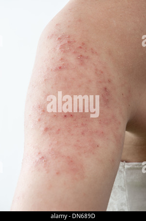 allergische Dermatitis Hautausschlag Hautbeschaffenheit des Patienten Stockfoto