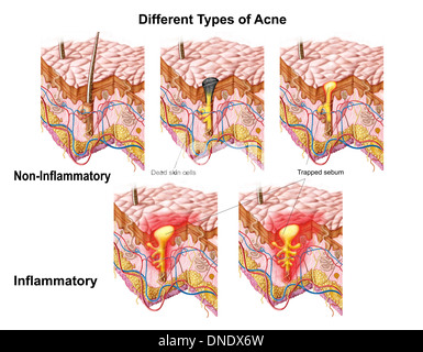 Verschiedene Arten von Akne, nicht-entzündliche und entzündliche. Stockfoto