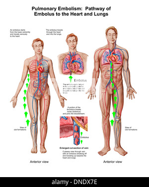 Lungenembolie, Weg der Lungenembolie zu Herz und Lunge. Stockfoto
