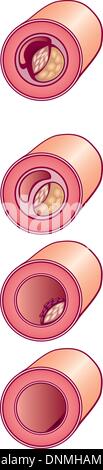 Abbildung des schlechten Cholesterins im Sinne Abschnitt Stock Vektor