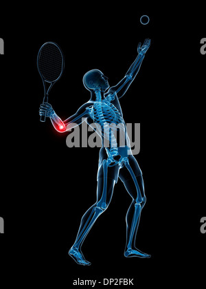 Tennisarm, artwork Stockfoto