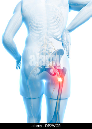 Schmerzhafte Ischiasnerv, artwork Stockfoto