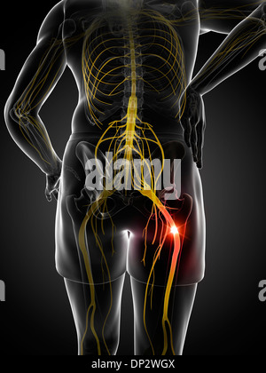 Schmerzhafte Ischiasnerv, artwork Stockfoto