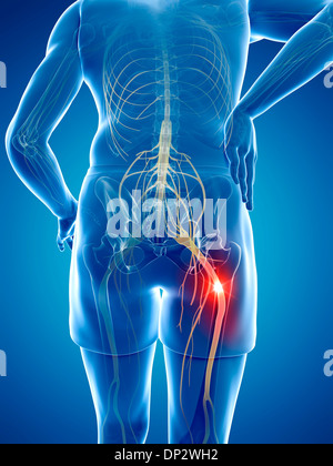 Schmerzhafte Ischiasnerv, artwork Stockfoto