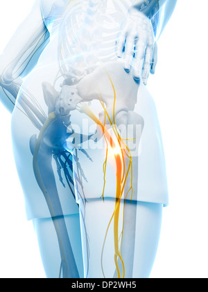 Schmerzhafte Ischiasnerv, artwork Stockfoto