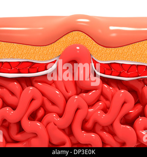 Ventrale Hernien, artwork Stockfoto