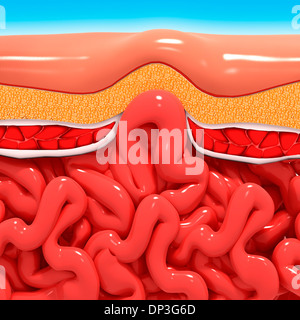 Ventrale Hernien, artwork Stockfoto