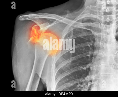 Ausgekugelte Schulter, x-ray Stockfoto