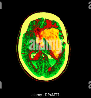 Hirnblutung, MRT-Untersuchung Stockfoto