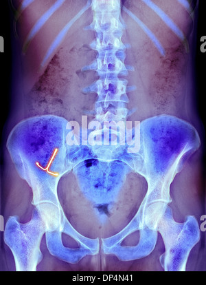 Ektopische IUD Verhütungsmittel, x-ray Stockfoto