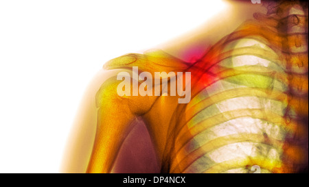 Gebrochenen Schlüsselbein, x-ray Stockfoto