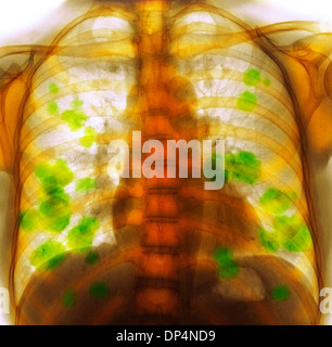 Sekundäre Lungenkrebs, x-ray Stockfoto