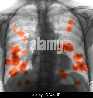 Sekundäre Lungenkrebs, x-ray Stockfoto