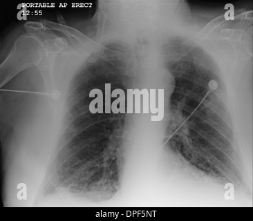 Röntgenuntersuchung der Brust zeigt COPD Stockfoto