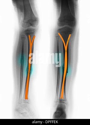 x-ray zeigt schien- und Wadenbein Fraktur Stockfoto