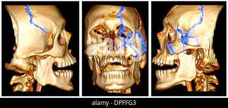 3D CT-Scan Bild von einem Schädelbruch Stockfoto