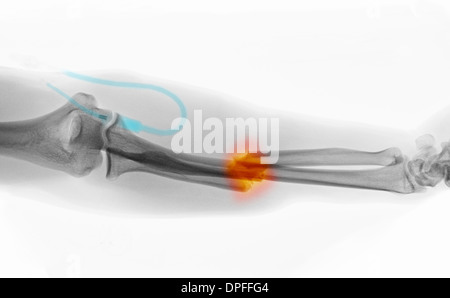 X-ray zeigt eine Fraktur des Radius und ulna Stockfoto
