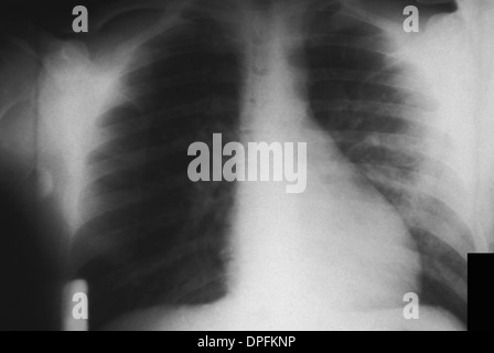 Röntgen-Thorax einer pulmonalen Infektion in Pest Stockfoto