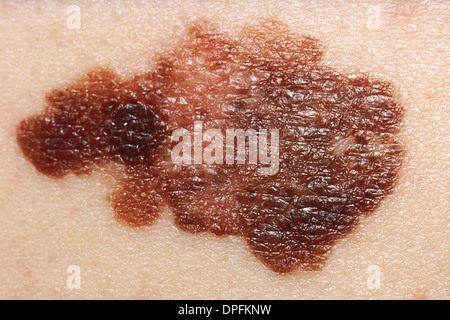 Melanom, Hautkrebs Stockfoto