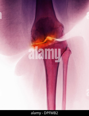 Röntgen des Knies mit Arthrose Stockfoto