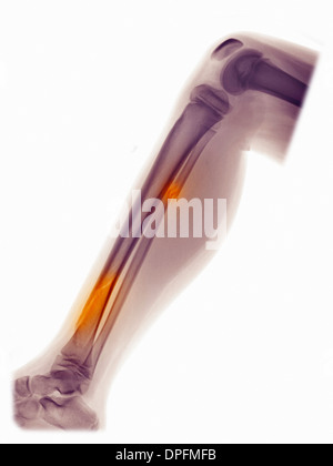 X-ray von Bein, Fraktur der Fibula und tibia Stockfoto