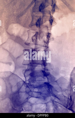 Röntgenaufnahme des normalen Lendenwirbelsäule Stockfoto
