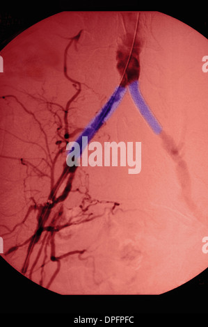 Aorta Angiogramm mit Stent Platzierung Stockfoto