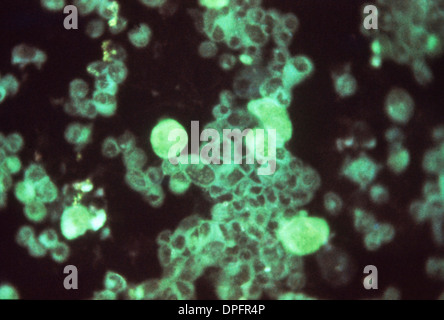 Cytomegalovirus in menschlichen embryonalen Lunge Stockfoto