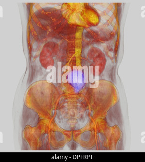 CT-Scan-Bild zeigt einen abdominalen Aortenaneurysma Stockfoto