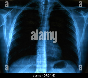X-Ray Image des menschlichen gesunde Brust Stockfoto