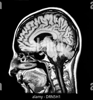 Senkrechten Teil des menschlichen Gehirns MRI scan Stockfoto