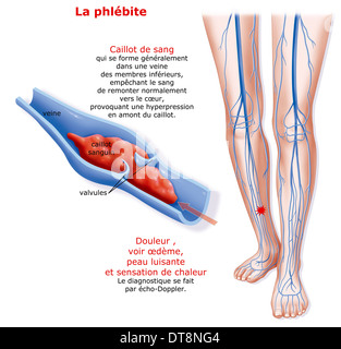 TIEFE VENENTHROMBOSE Stockfoto